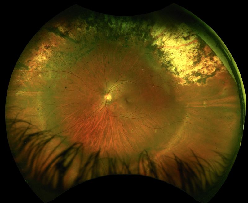 360 Encircling band & Supero Temporal Buckle OptosOptos Retinal Imaging