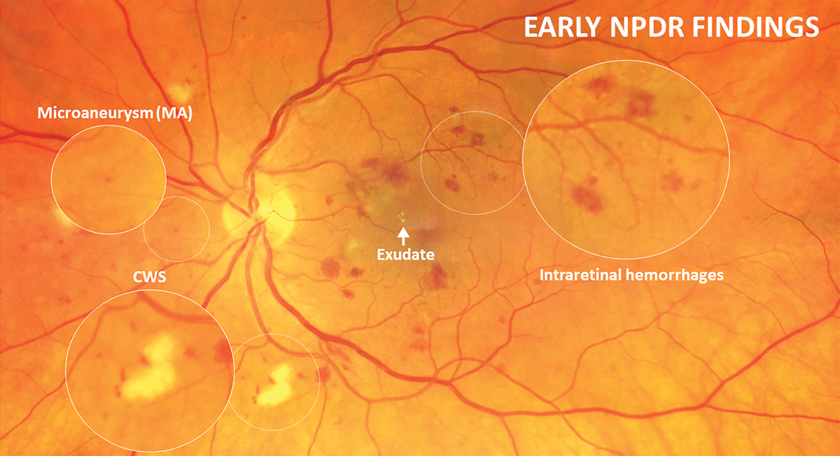 DM OptosOptos Retinal Imaging