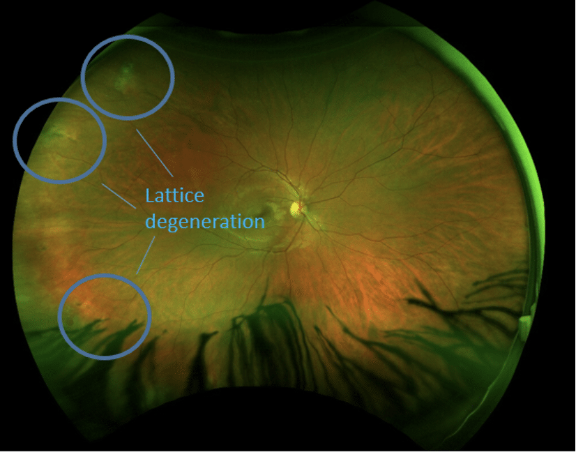 Lattice Degeneration OptosOptos Retinal Imaging
