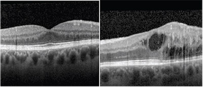 Optical Coherence Tomography_OCT Scans The Monocle2