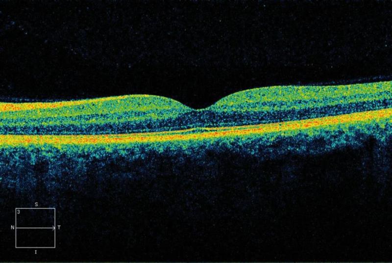Optical Coherence Tomography_OCT Scans The Monocle4