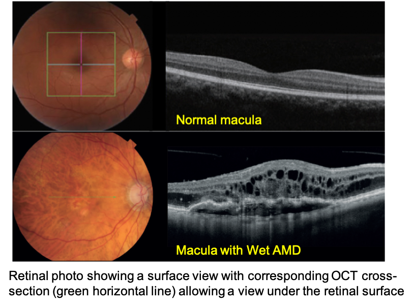 Optical Coherence Tomography_OCT Scans The Monocle5