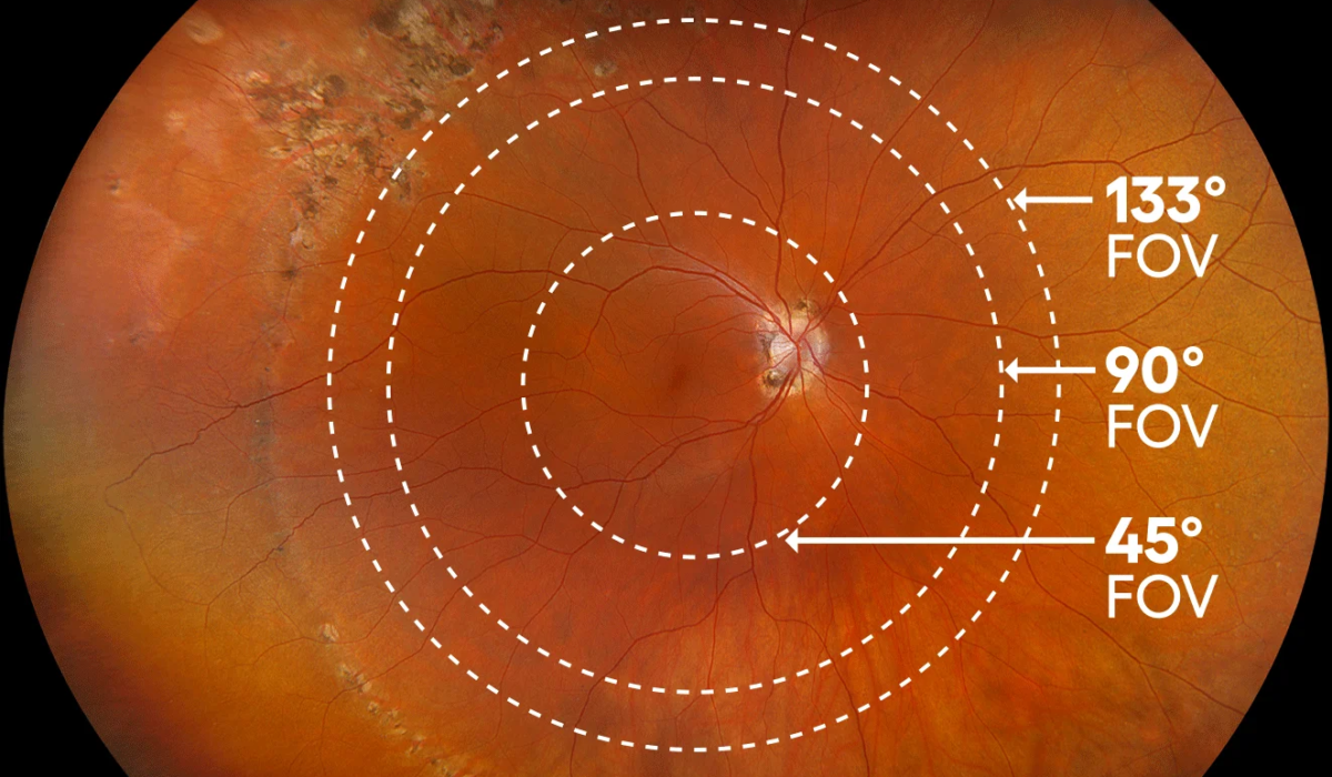 optos-home-hero_fov-rings-blackbkgd-2Optos Retinal Imaging